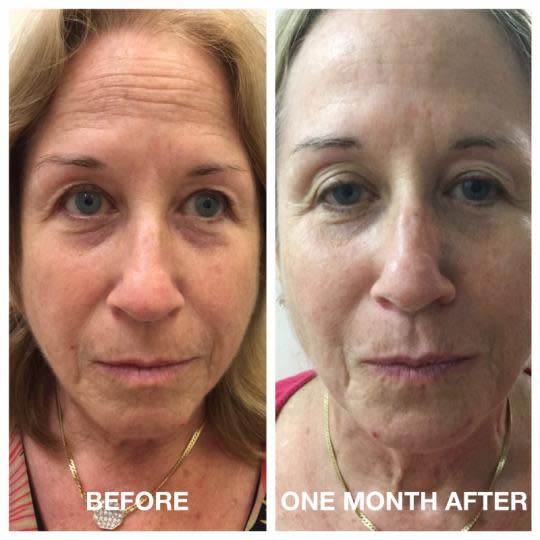 I Sent My Mom for Ultherapy Instead of a Facelift