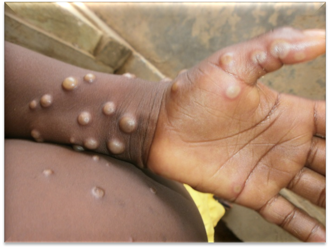 ‘Absolutely be concerned.’ Monkeypox cases are surging in South Florida