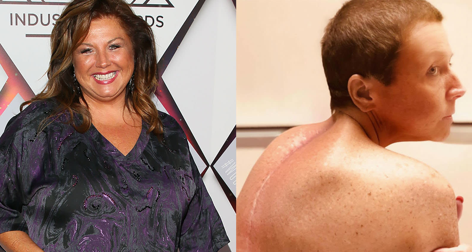 Abby Lee Miller Spinal Surgery Scar Cancer