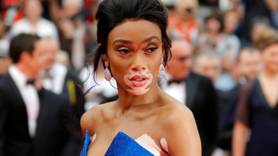 Winnie Harlow shares revealing selfie to celebrate unique beauty