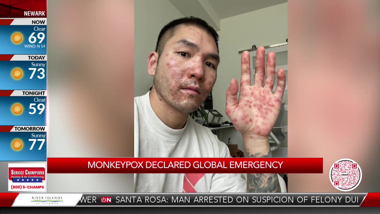 Emeryville Man Details Recovery from Presumed Case of Monkeypox Virus - The  E'ville Eye Community News