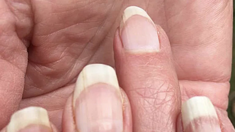 Dents nails have