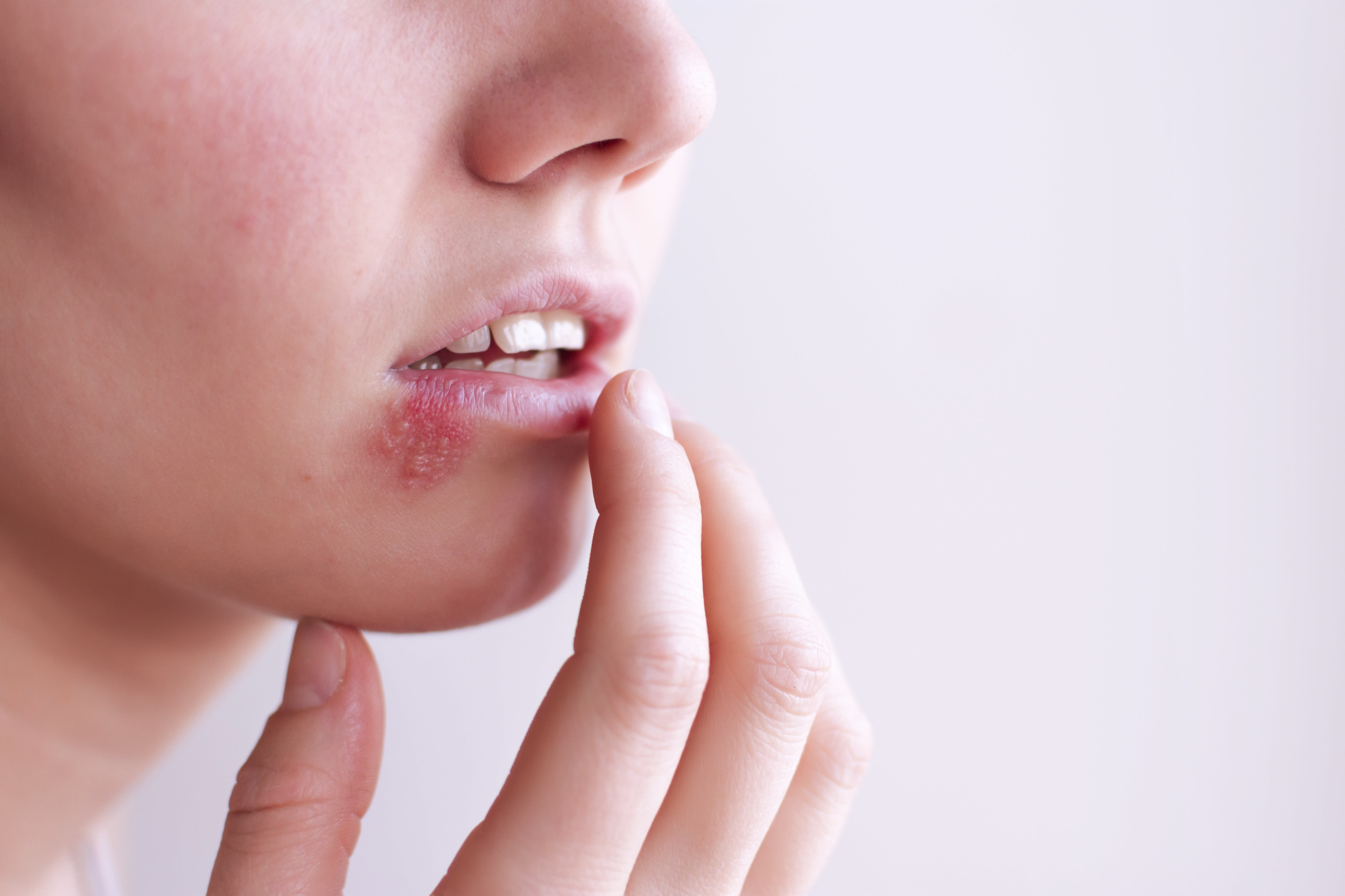 Breaking Down The Differences Between Oral And Genital Herpes Aka Hsv 1 And Hsv 2