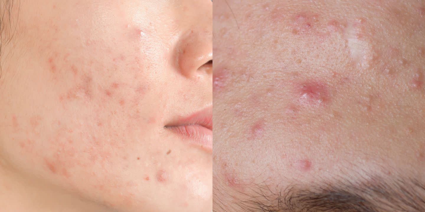 your-diet-may-be-why-you-still-have-acne