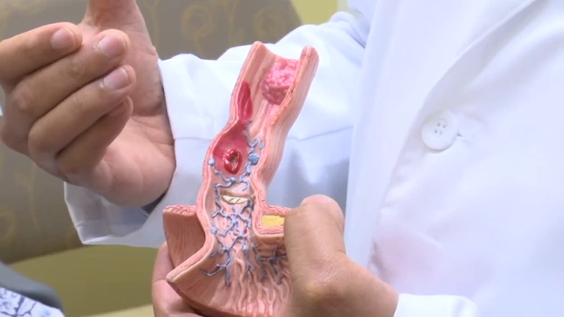 UCI doctors offer minimallyinvasive treatment for early