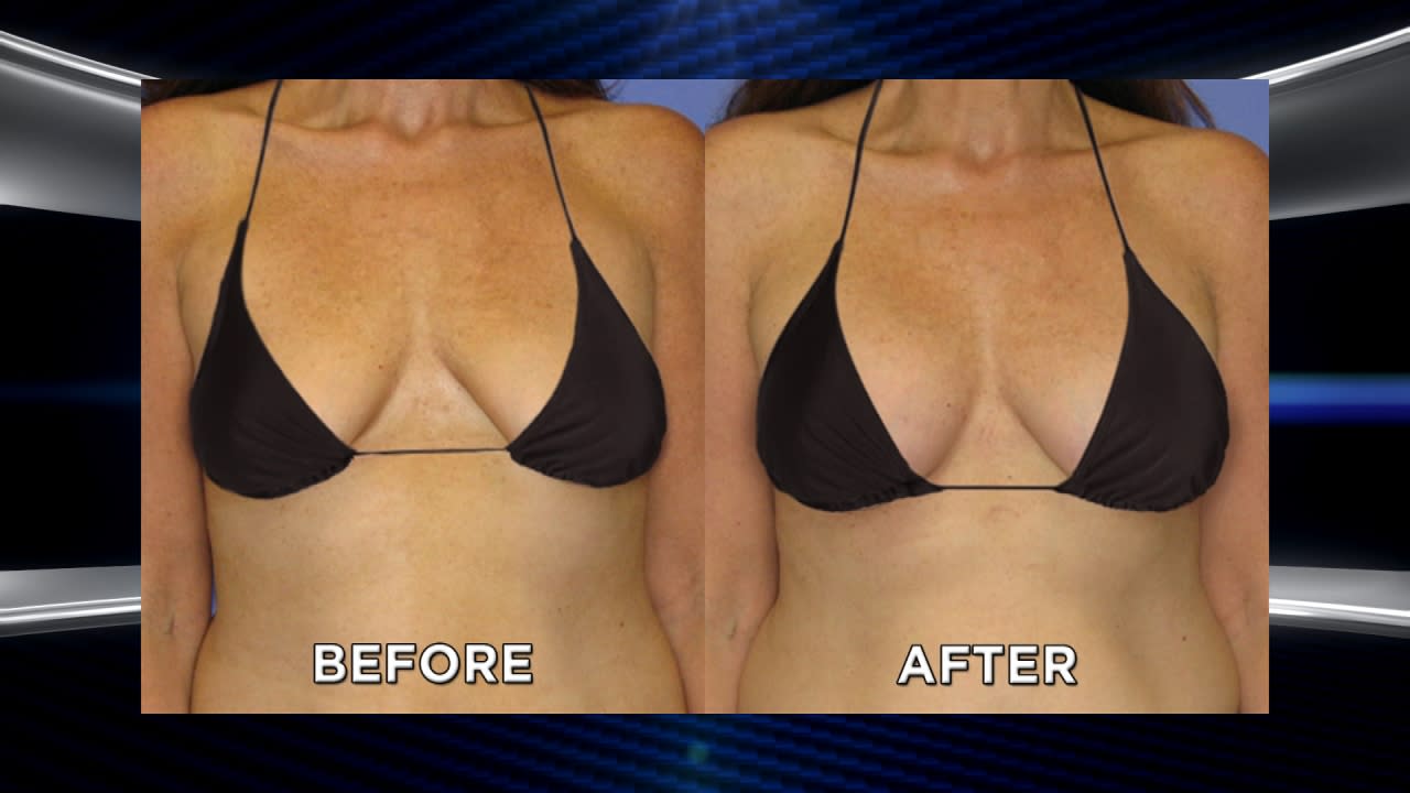 Womans Weight Loss Makeover Is Completed With Breast Lift