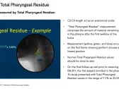 Benitec Biopharma Reports Continued Durable Improvements in the Radiographic Assessments of Swallowing Efficiency and the Subject-Reported Outcome Instrument at the 180-Day Timepoint for First OPMD Subject Treated with Low-Dose BB-301 in Phase 1b/2a Study