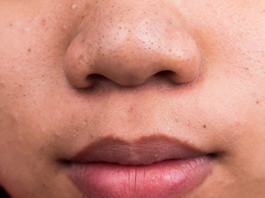 The blackheads on your nose are actually a form of acne. Here's how to get rid of them for good.