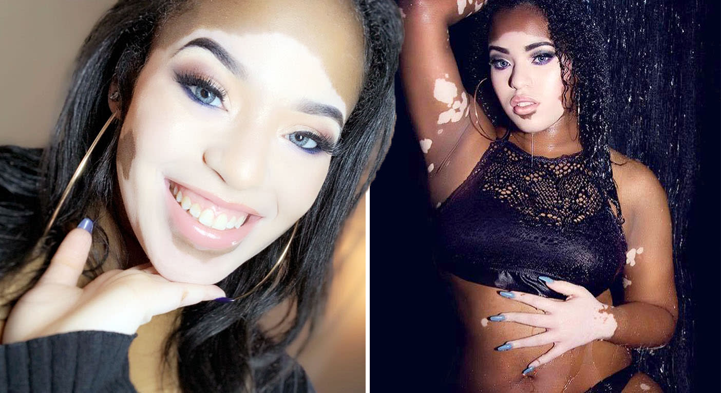  Model  with vitiligo  accused of trying to be white  