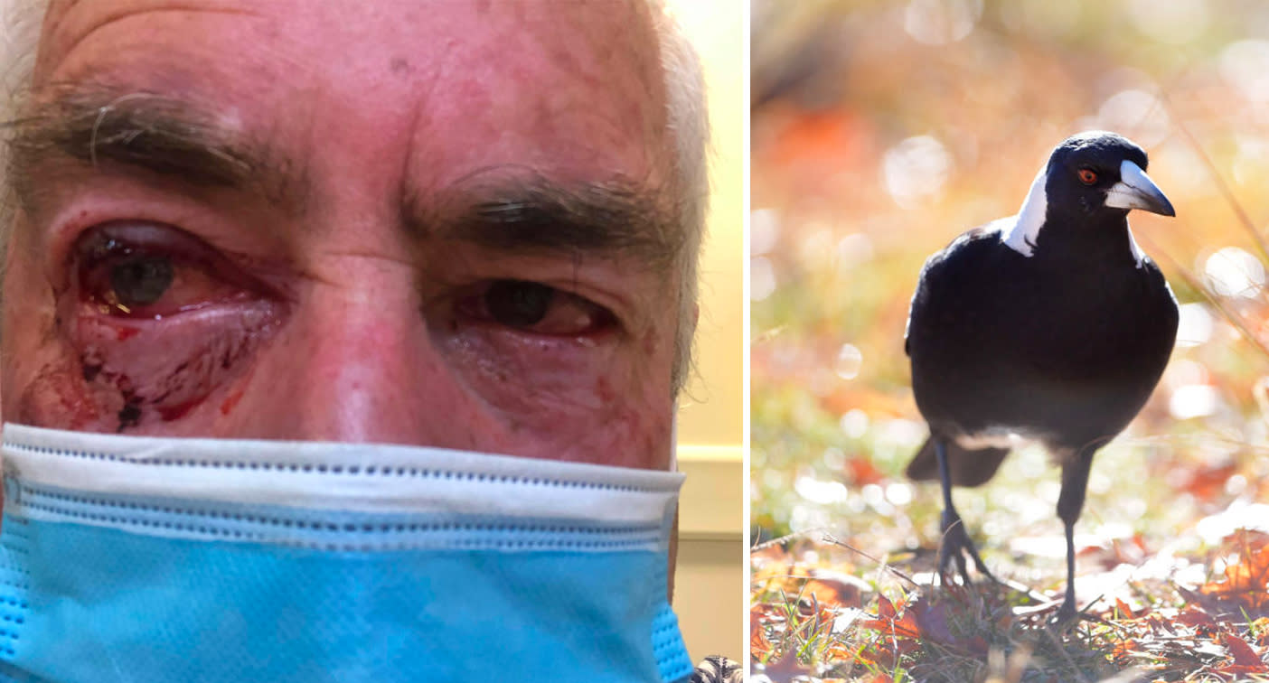 Magpie attacks man's eyes inflicting horrific injuries