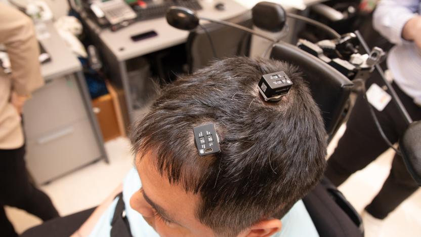 A man's head showing the external interfaces for his brain implants.