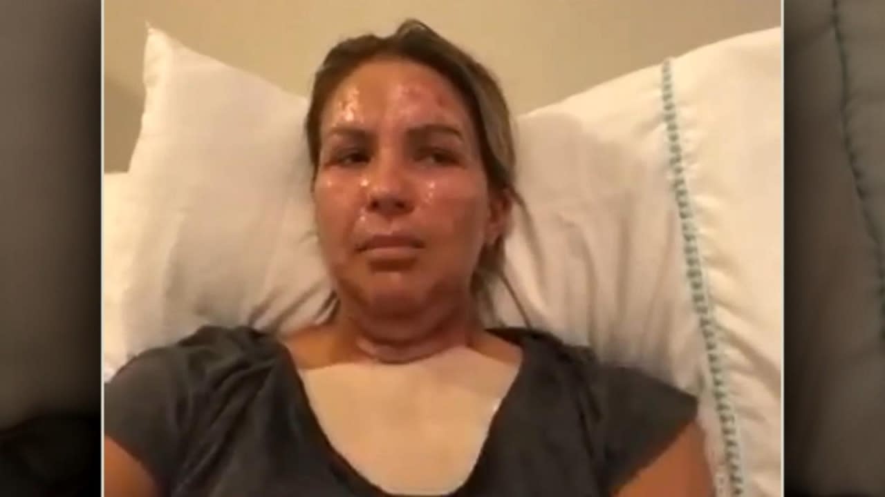 Mom speaks out after hand sanitizer goes up in flames, leaving her with burns Video