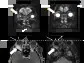 BriaCell Images Confirm Robust Anti-Tumor Activity in Patient with “Eye-Bulging” Metastatic Breast Cancer