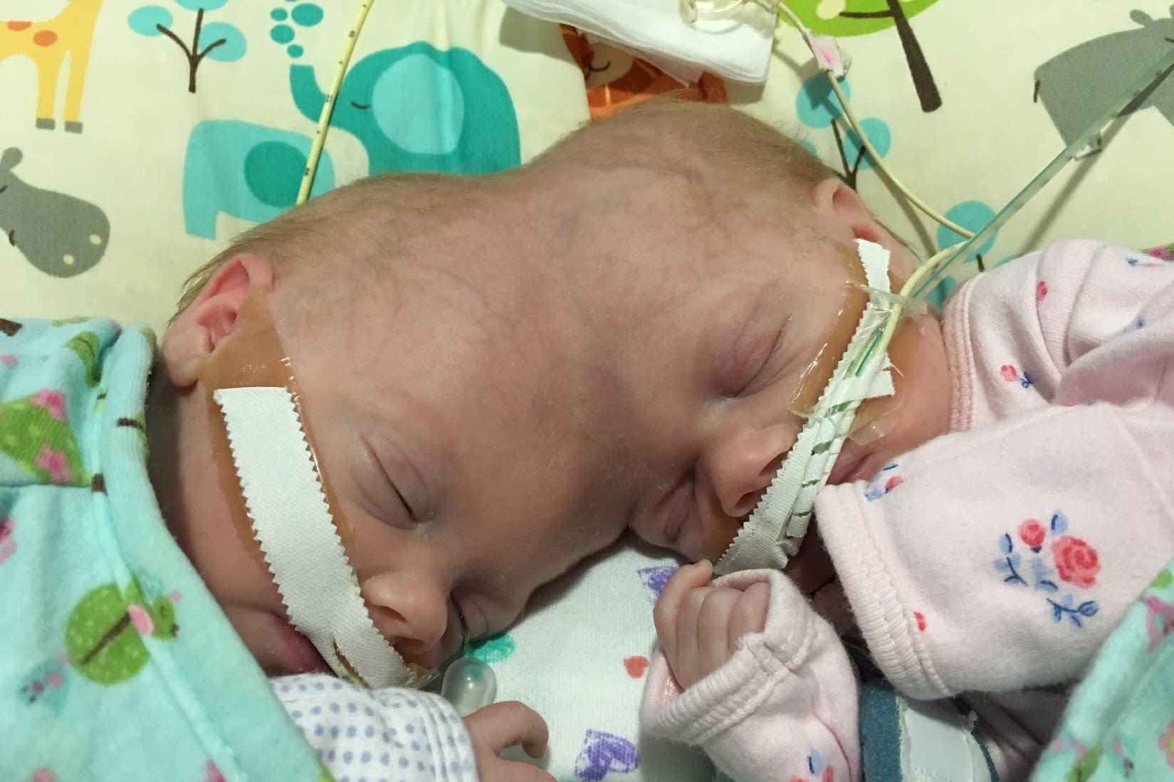 Conjoined Twins Thrive After Surgery Separates Them At The Head They