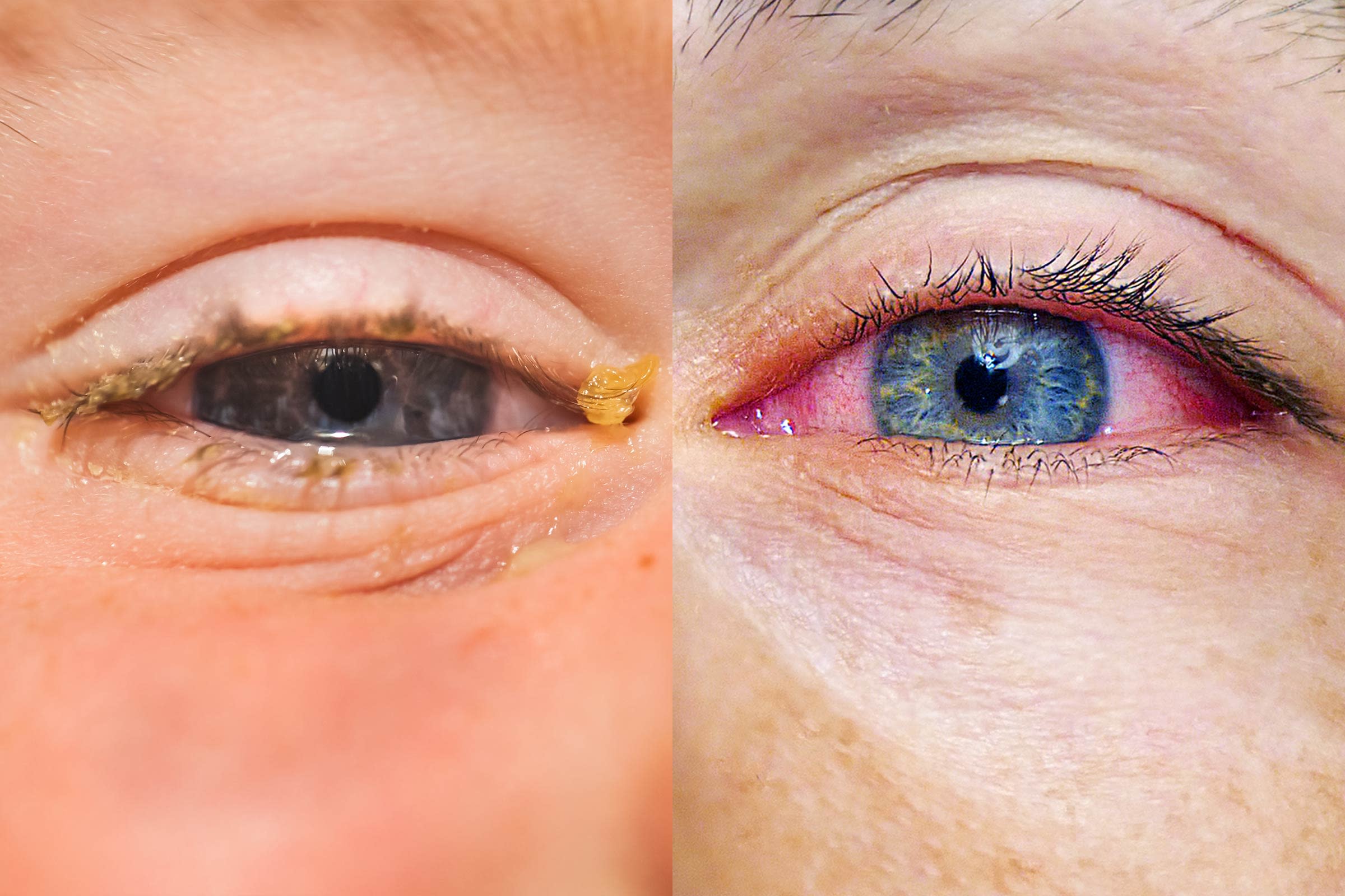 Allergies Or Pink Eye Here S How To Tell The Difference Pink Eyes My