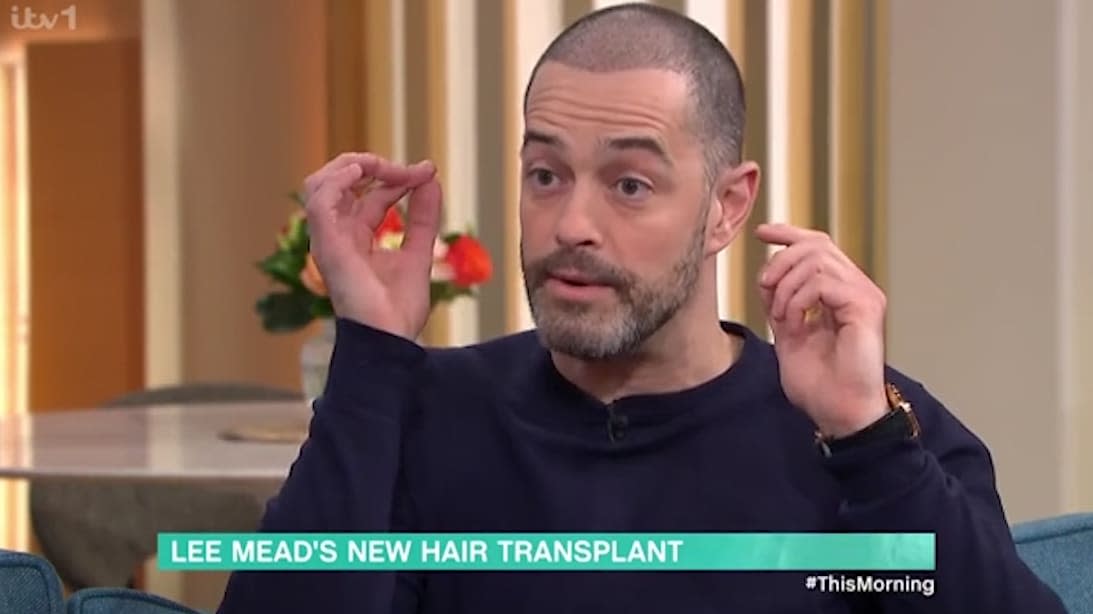 Lee Mead says hairline 'affected confidence' before transplant